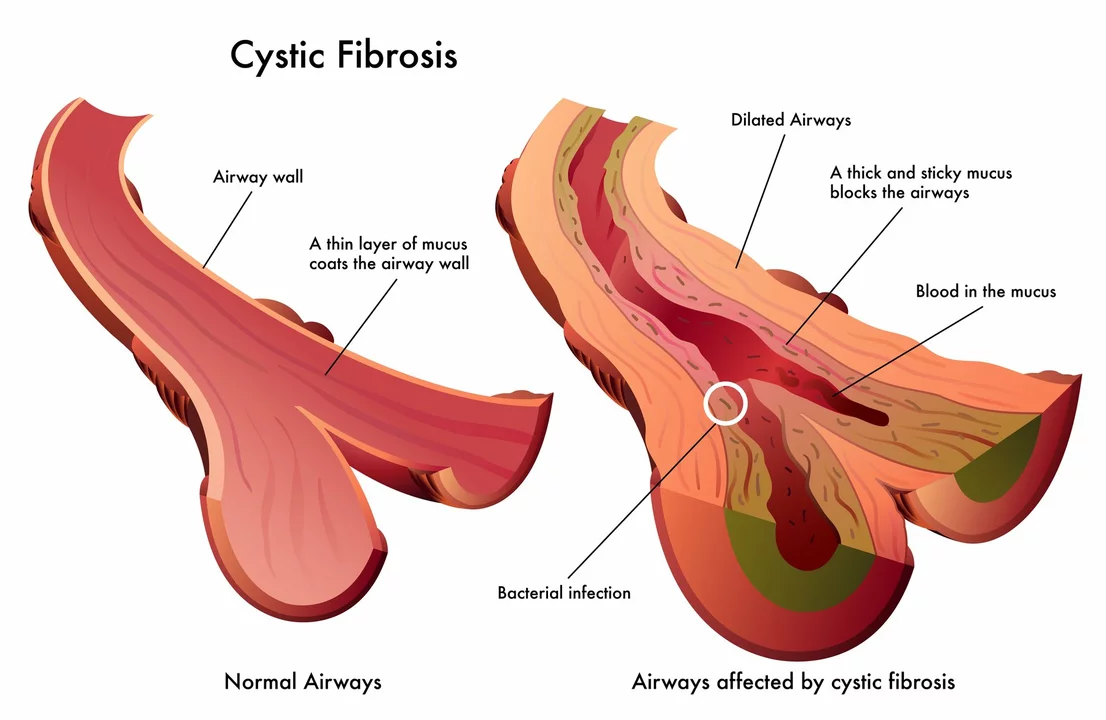 The Benefits of Atorvastatin for Patients with Cystic Fibrosis