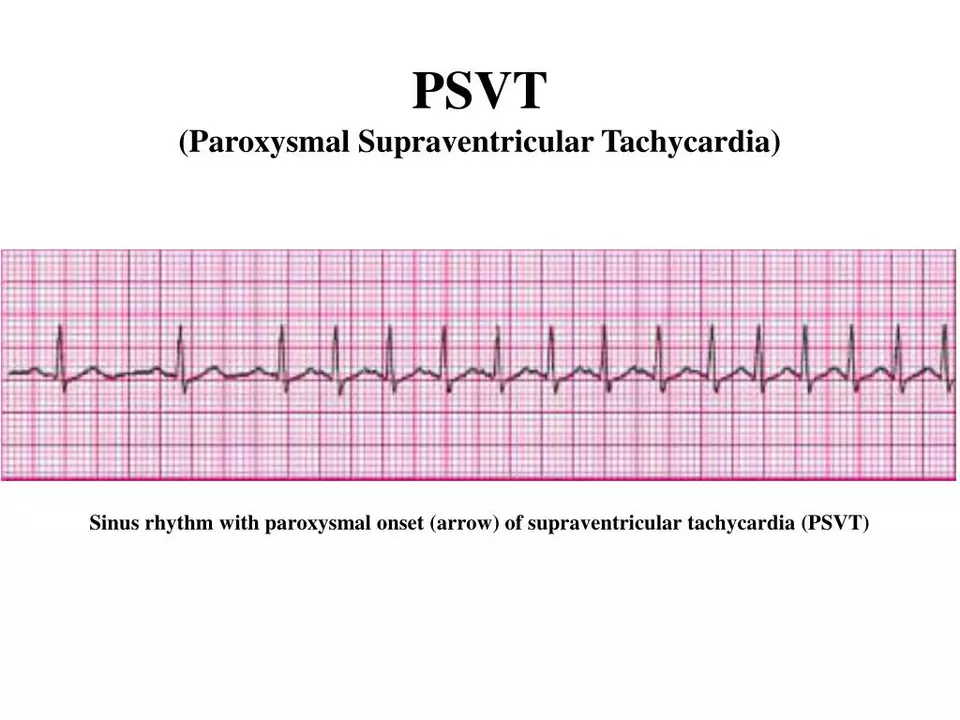 Amiodarone and the Management of Refractory Supraventricular Tachycardia