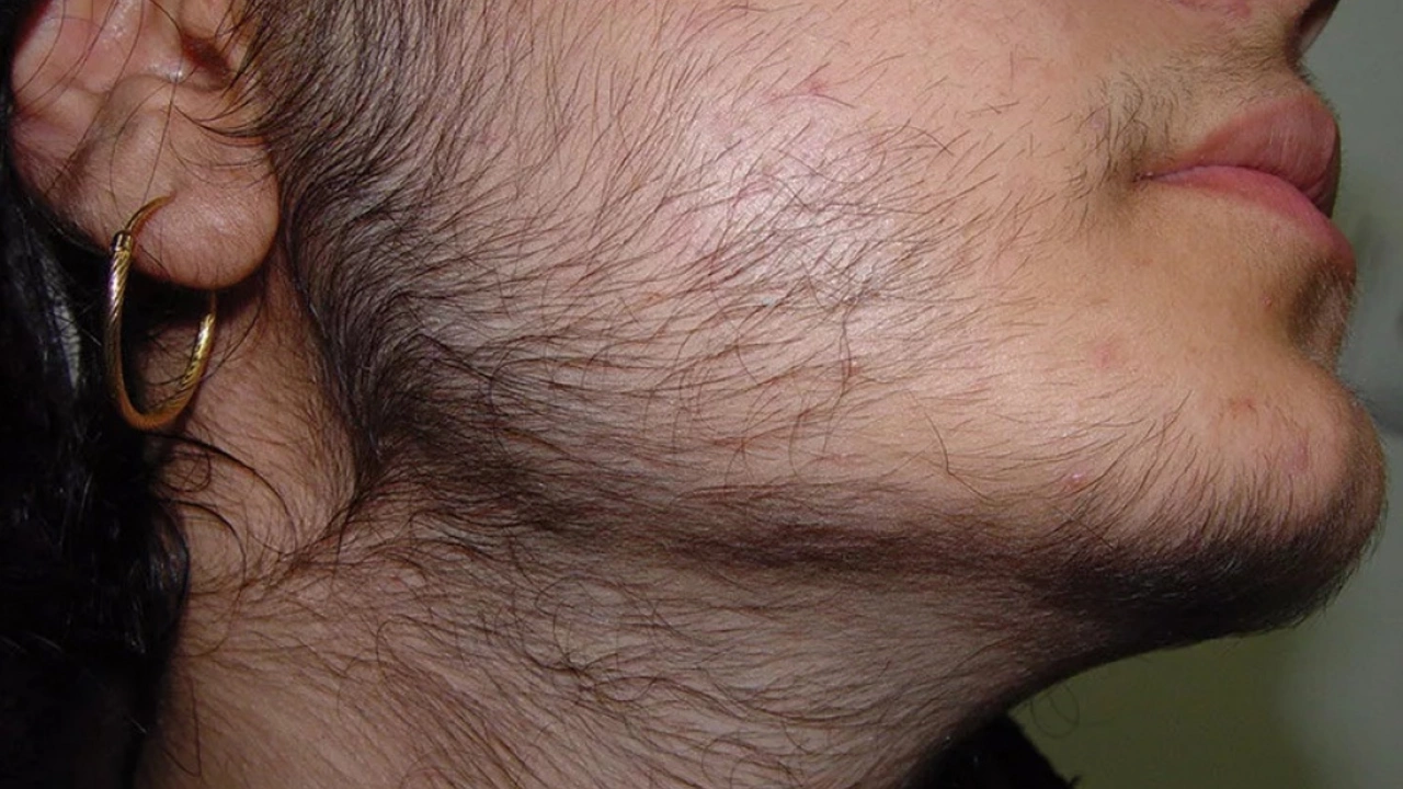 Hirsutism and Body Hair: A Historical Perspective