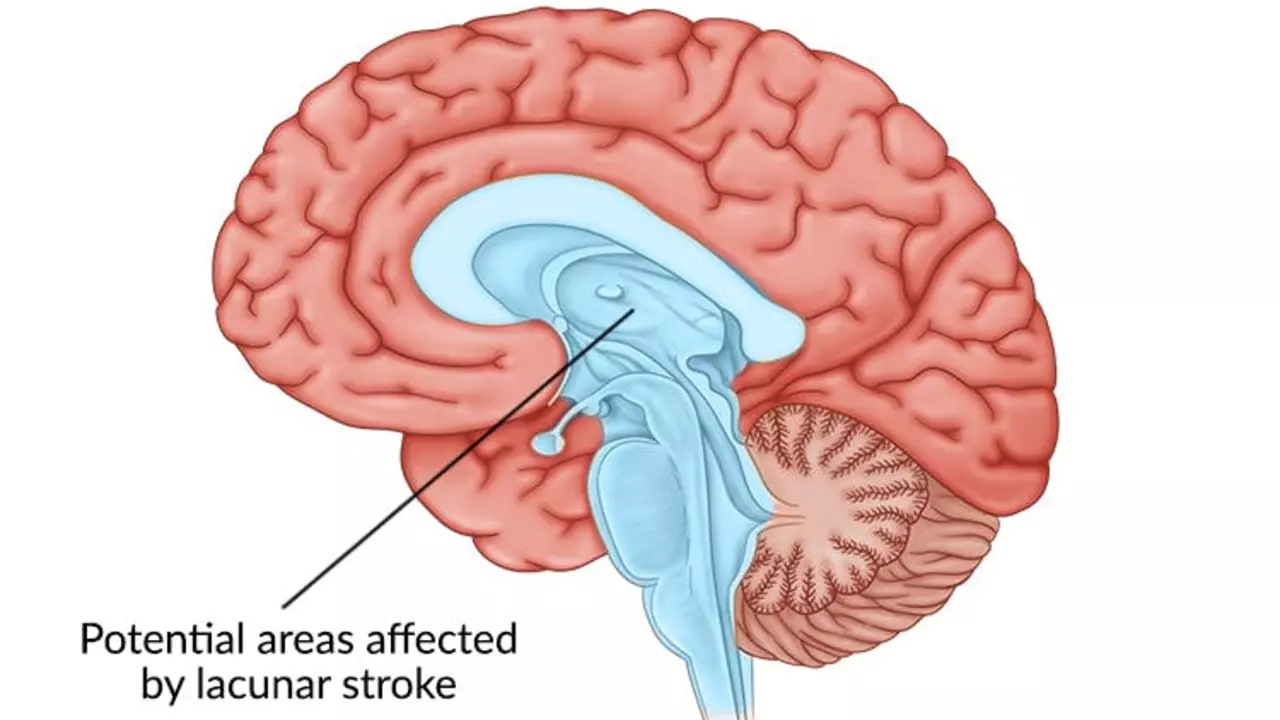 Understanding the Different Types of Strokes and Their Causes